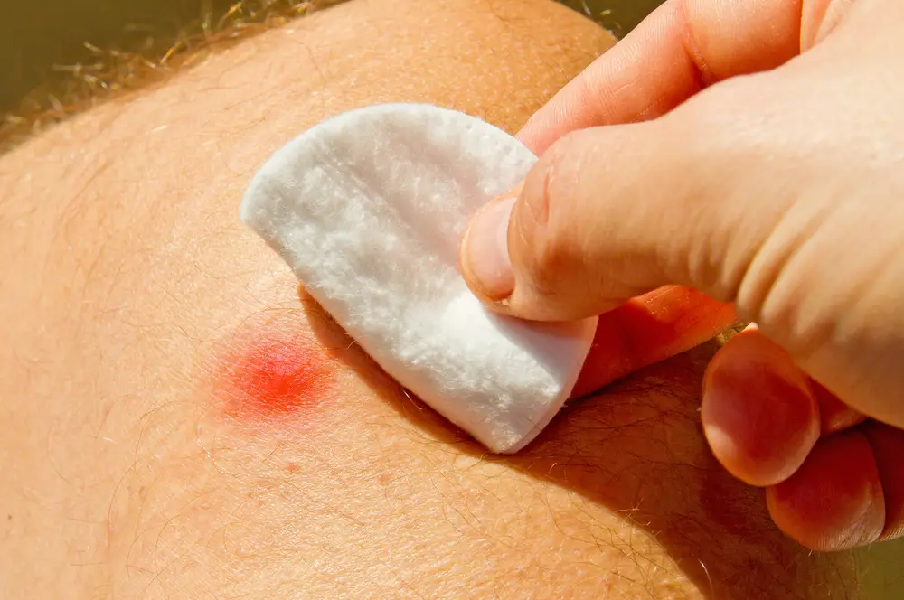 A closeup of someone treating an insect sting.